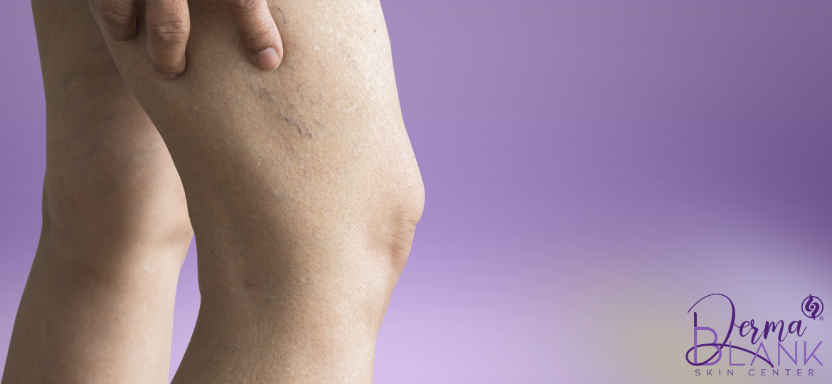 Derma Blank Skin Center | Escleroterapia