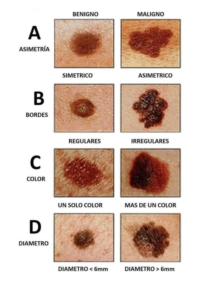 Derma Blank Skin Center | Tabla de nevos